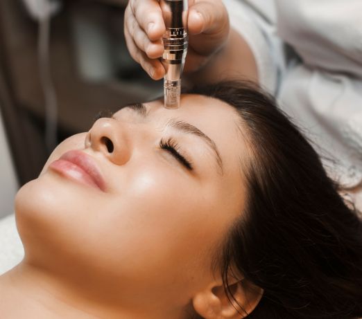 microneedling for acne scars